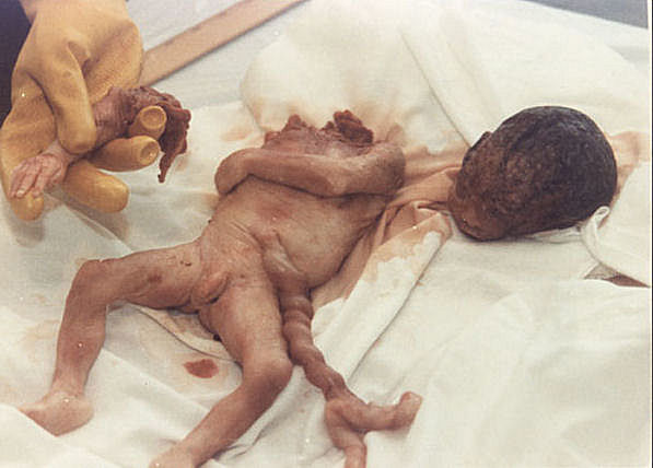 Abortion Photo