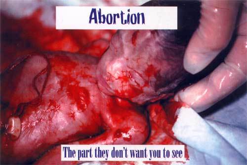 Abortion: The part they don't want you to see.