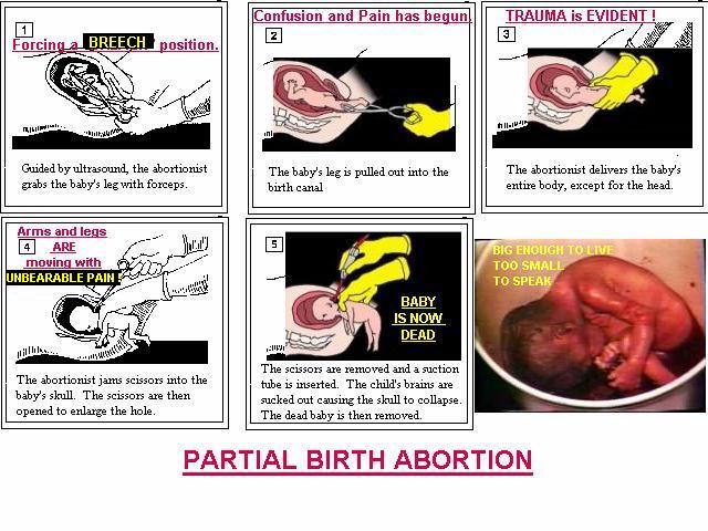 Partial Birth Abortion